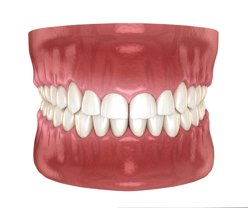 Dental Crown Lengthening: Benefits Uncovered