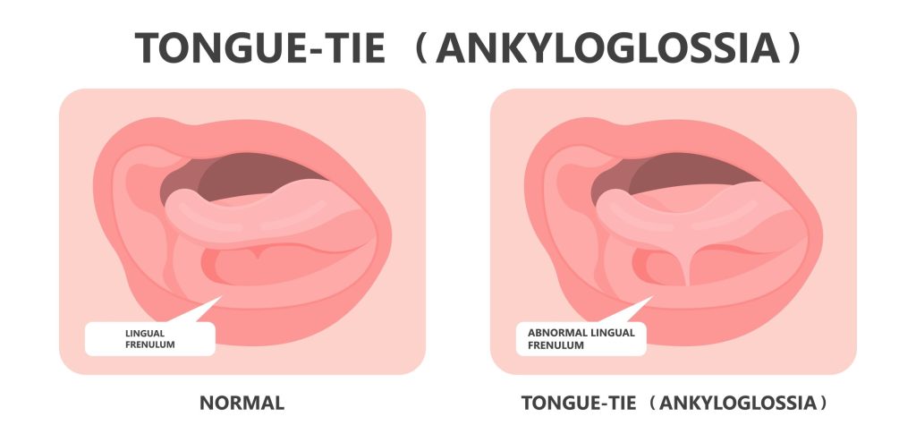 Understanding Frenectomy: A Comprehensive Guide