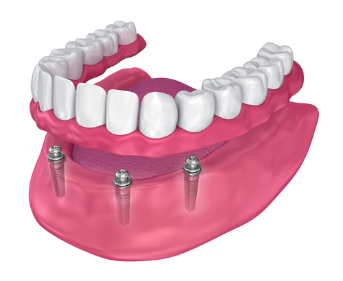 Understanding Overdentures: A Comprehensive Guide