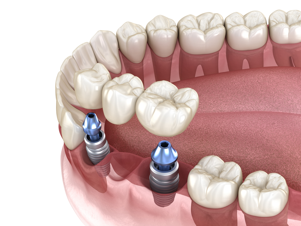 Dental Implants vs. Dentures: What's Right for You?