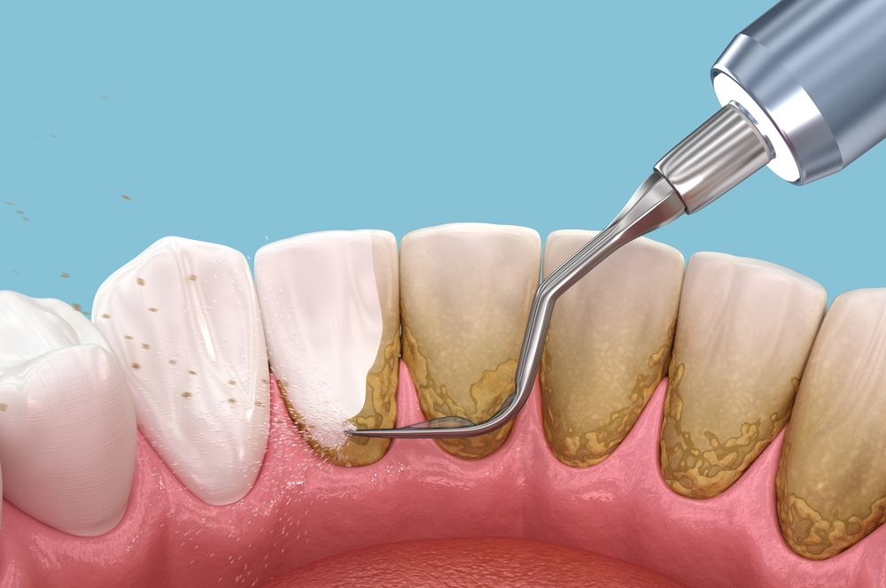 What Happens During a Periodontal Maintenance Visit?