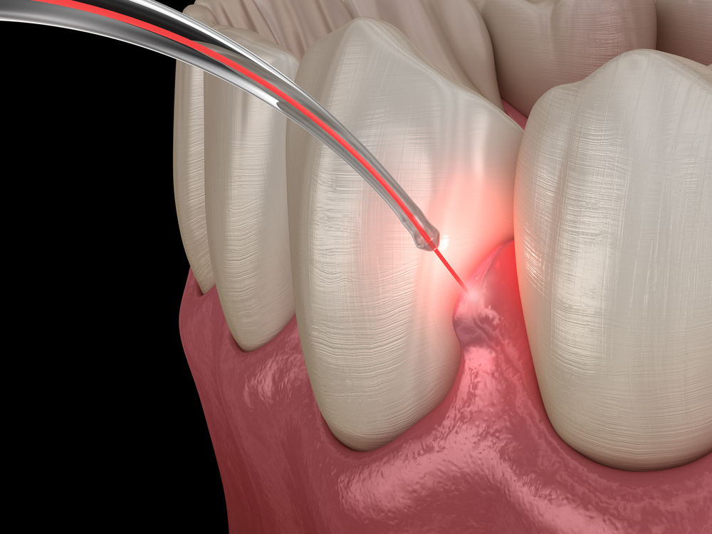 Laser Gum Therapy: A Minimally Invasive Option for Periodontal Disease