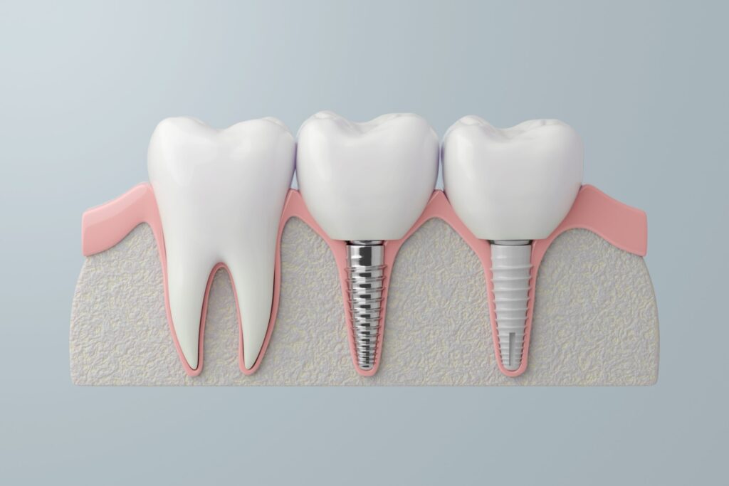 Zirconia Implants at Palm Beach Periodontics