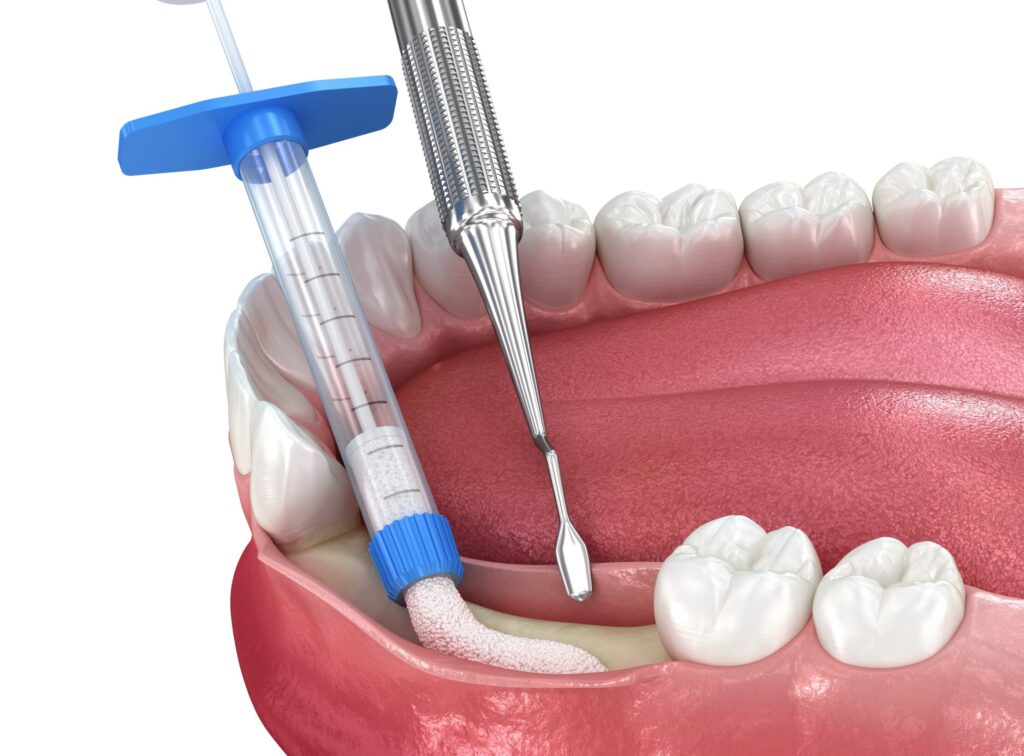 Dental Bone Grafting for Implant Success